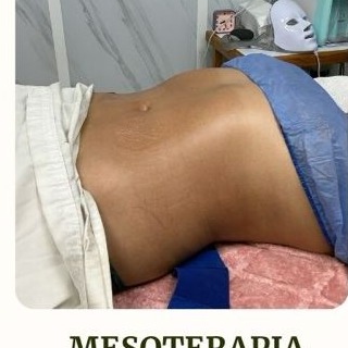 Mesoterapia corporal