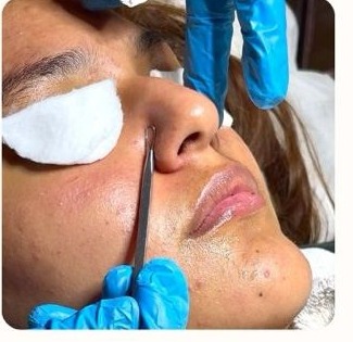 Limpieza facial profunda